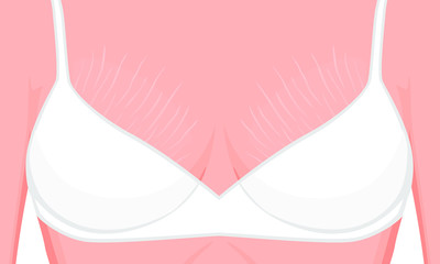 Vector illustration of a human body problem. Stretch marks on European, Asian female or woman breast. For advertising, medical publications, use on package of medicinal products, creams, lotion