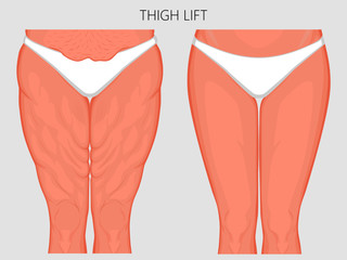 Vector illustration of a human body problem - fatty thighs and sagging skin correction before and after plastic thigh lift surgery. Front view. For advertising and medical publications