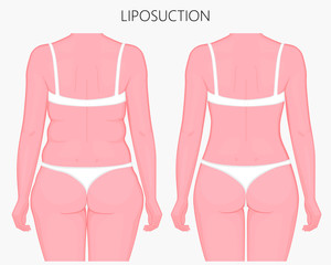 Realistic Vector illustration. Liposuction, waist, hips, buttocks and thighs plastic surgery in woman.Back view. For advertising of esthetic cosmetic procedures; for medical publications
