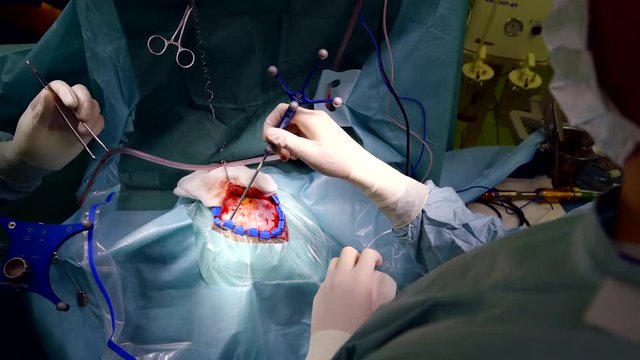 Surgeons do surgery to trepanation of the skull. Tumor removal.