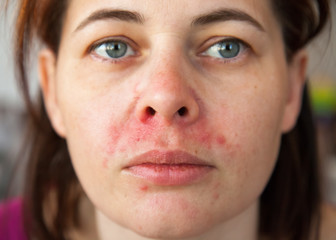 woman's face with perioral dermatitis - obrazy, fototapety, plakaty