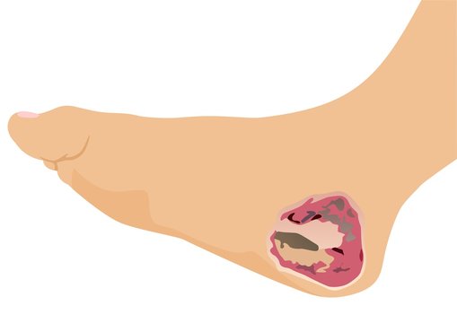 Acinetobacter Infection