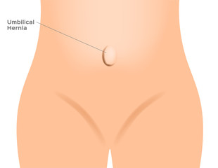 umbilical hernia / intestine / human anatomy / belly vector