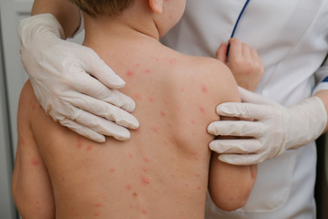 Doctor examines baby's skin full of blisters,scar and rash caused by chicken pox