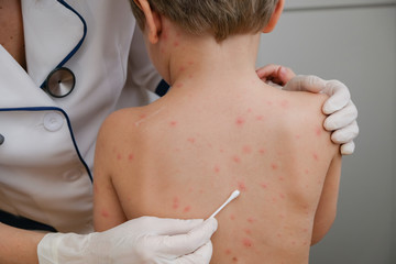 Doctor applying cream to baby's skin with blisters and rash caused by chickenpox