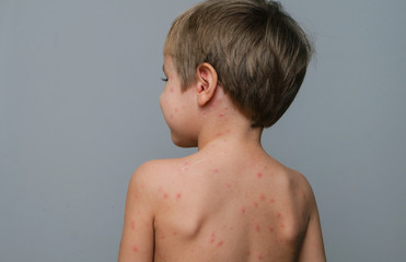 Closeup of back and neck full of blisters,scar and rash caused by chickenpox