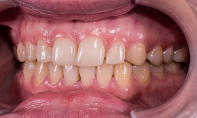 Obraz premium Healthy human teeth with normal occlusion from side view