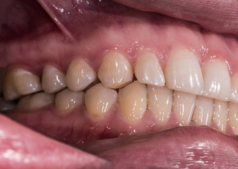 Healthy human teeth with normal occlusion from side view