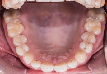 Healthy human teeth - incisors, frontal close up view