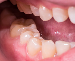 Healthy human molar teeth close up view