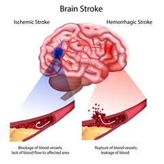 Stroke types poster, banner. Vector medical illustration. white background, anatomy image of damaged human brain, blocked and ruptured blood vessels.