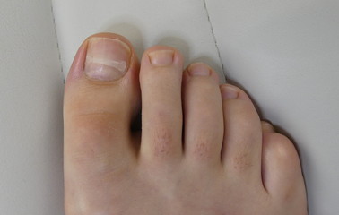 Ingrown toenail, toenail clamp