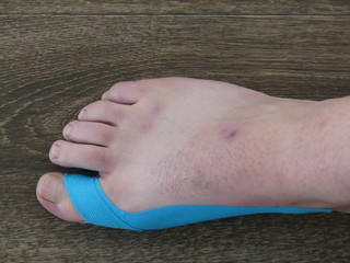 Medical Taping Hallux Valgus