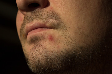 Obraz premium Acne inflammation on young skin and care for it