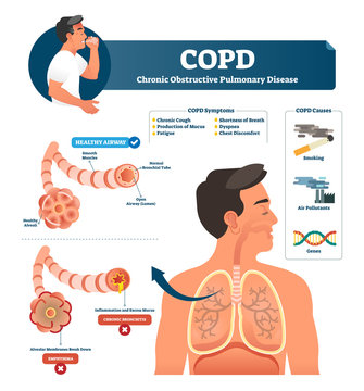 COPD vector illustration. Labeled chronic obstructive pulmonary explanation