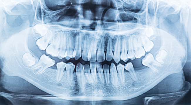 panoramic dental x-ray of a mouth left and right side.