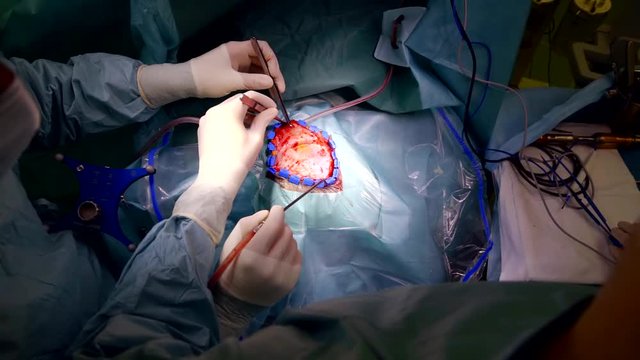 neurosurgery carries out the operation of craniotomy. preparing for the brain dissection. specialist relieve additionally to saw cut the bone of the skull