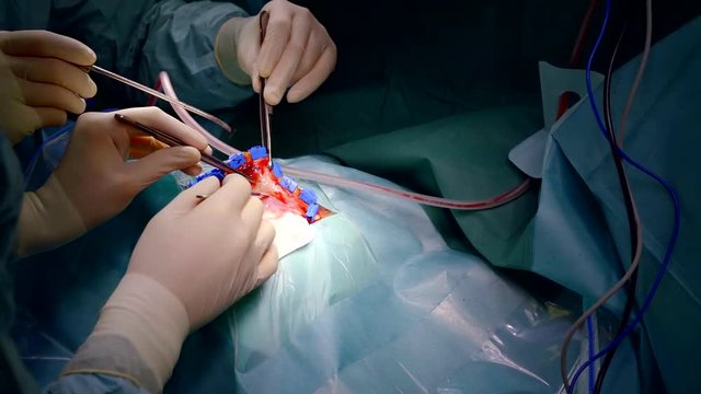 neurosurgery carries out the operation of craniotomy. preparing for the brain dissection. specialist scalpel cuts and separates the head skin to the skull