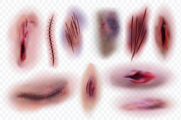 Realistic scars. Wound, surgical stitches and bruis, skin cuts. Bloody wounds vector isolated set. Illustration of surgical scratch, cut wound and seam