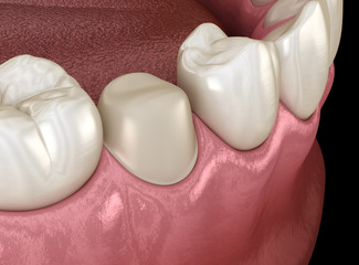 Preparated premolar tooth for dental crown placement. Medically accurate 3D illustration