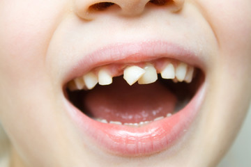 The baby girl smiling and shaking wobbly milk tooth in open mouth with her finger. First molar teeth. Health care, dental hygiene and childhood concept