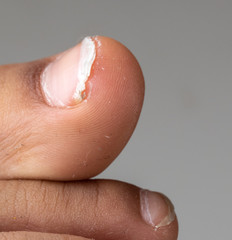 Closeup of adult toenails