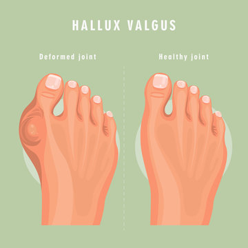 Hallux valgus vector medicine poster. Colorful design. Detailed image with text.