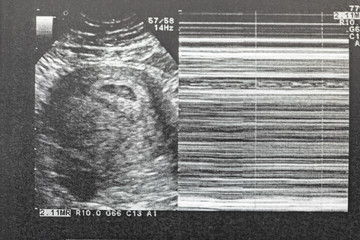 Ultrasound of baby in mother's at hospital.