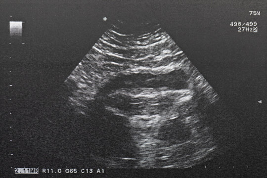 Ultrasound of baby in mother's at hospital.