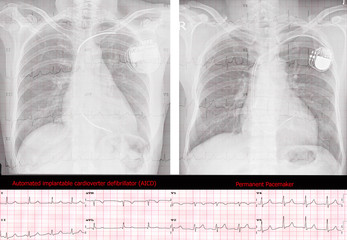 Automated implantable cardioverter defibrillator (AICD) and Permanent Pacemaker.