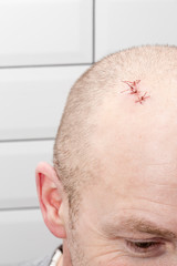 On the man’s head there is a wound with sutures, after injury. Close-up.