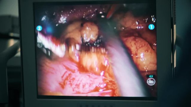 Surgical robot display in hospital with robotic technology equipment, machine arm surgeon in futuristic operation room. Minimal invasive surgical medical robot, bariatric surgery with robotic assisted