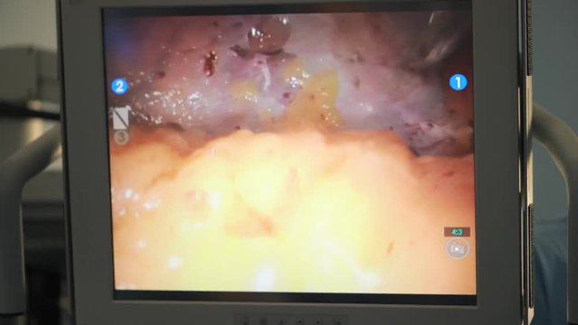 Surgical robot display in hospital with robotic technology equipment, machine arm surgeon in futuristic operation room. Minimal invasive surgical medical robot, bariatric surgery with robotic assisted