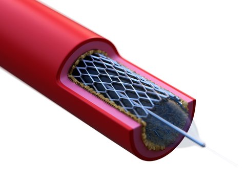 Illustration of a stent in action