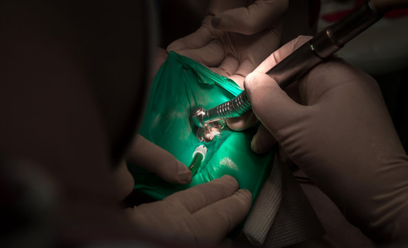 treatment of tooth caries, dental  close-up.