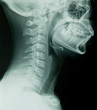 Lateral Head & Neck X-Ray 