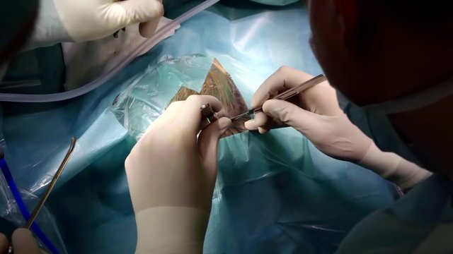 Close-up of a surgeon with a scalpel making an incision on head, surgical operation in a hospital.