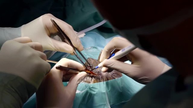 Close-up of a surgeon carefully making a small cut on patients head, cutting thick head skin.