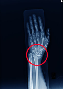 X-ray Left wrist joint Fracture with displacement distal end left radius.