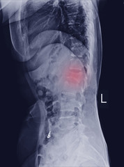 MRI scan of lumbar spines of a patient with chronic back pain showing degenerative change of lumbar...
