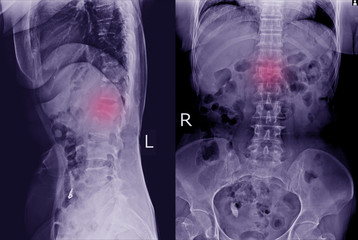 X-ray L-S Spine AP LATERAL: Finding Moderate compression fracture of L1 vertebra.