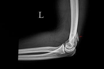 supracondylar fracture