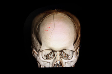 fractured skull