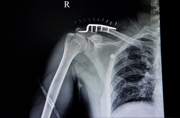 distal clavicle fracture and pulmonary tuberculosis