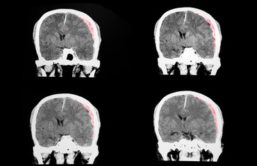 CT brain with large subdural hematoma
