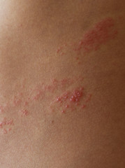 Fototapeta premium close up on zoster disease on human skin