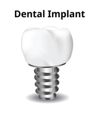 Dental Implant, Screw, isolated on white background, Realistic illustration Vector.