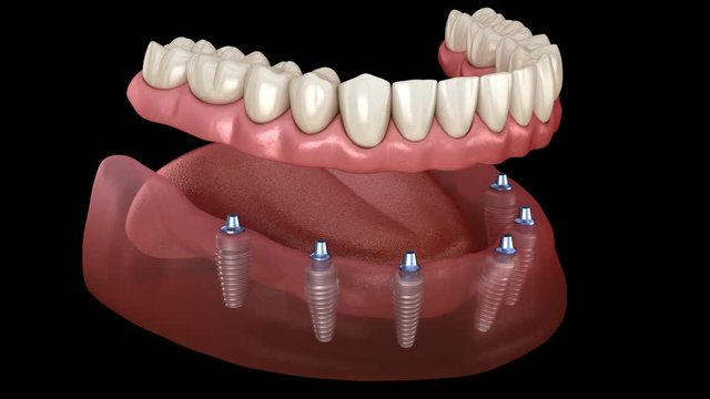 Mandibular prosthesis All on 6 system supported by implants. Medically accurate 3D animation of human teeth and dentures concept