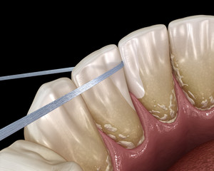 Oral hygiene: using dental floss for plaque removing. Medically accurate dental 3D illustration