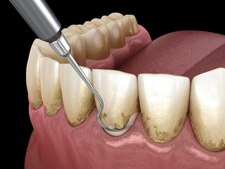 Oral hygiene: Scaling and root planing (conventional periodontal therapy). Medically accurate 3D illustration of human teeth treatment